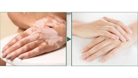 Dünyadaki birçok vitiligo hastası çareyi Bursa’da buluyor