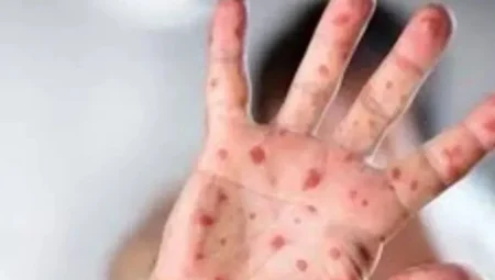 Maymun Çiçeği virüsüne karşı en dikkatli olması gereken sektör: Turizm