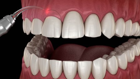 İmplant Nedir ve Hangi Durumlarda Tercih Edilir?