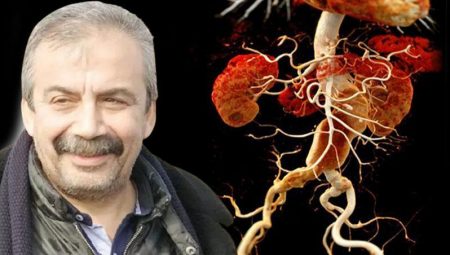 40-60 yaş ortası en riskli grup! Aort yırtılması kalp krizi ve felçle sonuçlanabilir