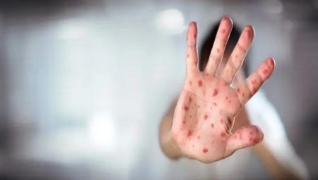 ABD’de kızamık paniği: Vaka sayısı 500’e yükseldi