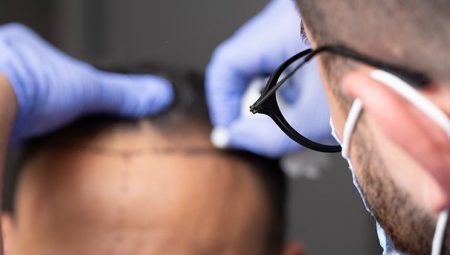 Ordudan 1 milyon sterlin çaldı, Türkiye’de saç ektirdi